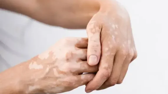 VITILIGO