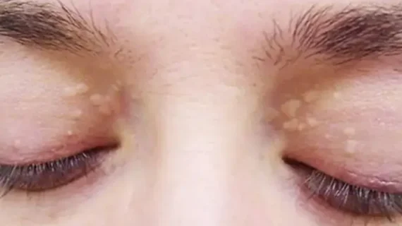 XANTHELASMA