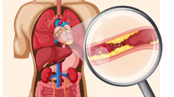 Arteriosklerosis