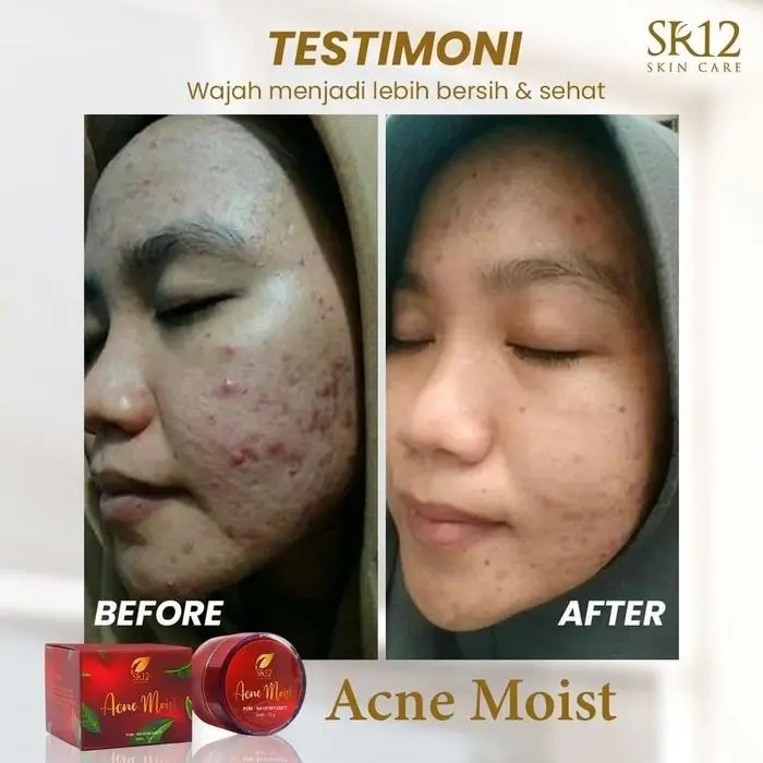 Acne Moist 3