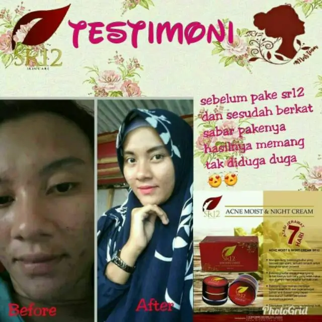 Acne Moist 4