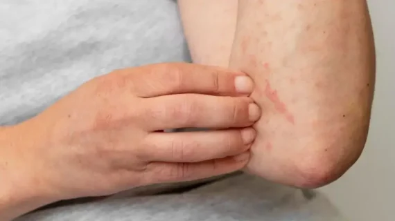 ALERGI