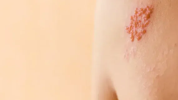 HERPES