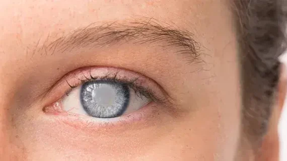 GLUKOMA