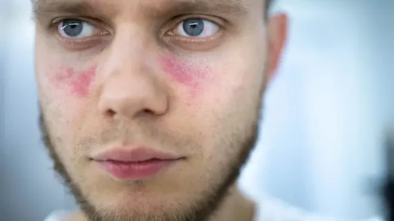 LUPUS