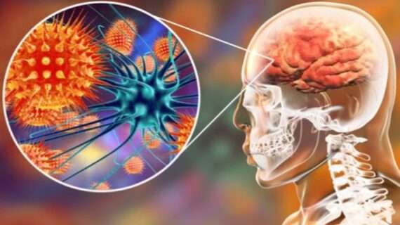 MENINGITIS