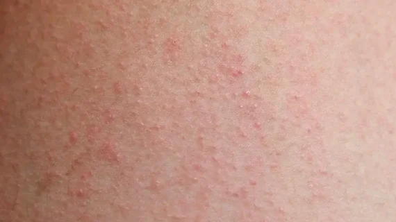 ALERGI