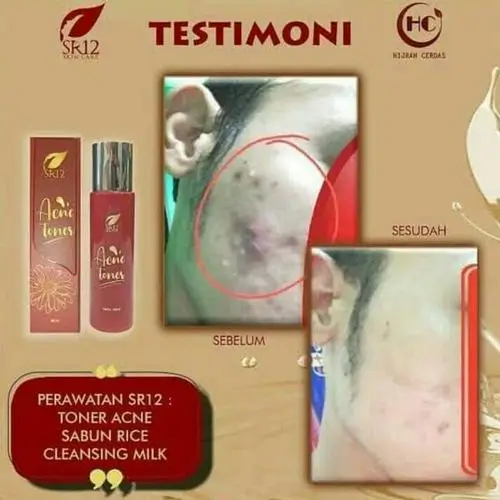 Acne Toner Premium 4