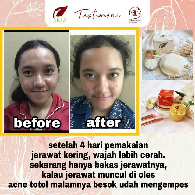 Acne Totol 5